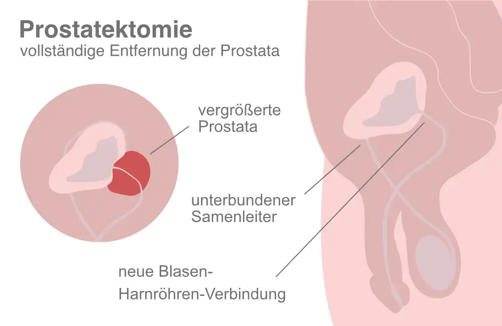 Schaubild Prostatektomie