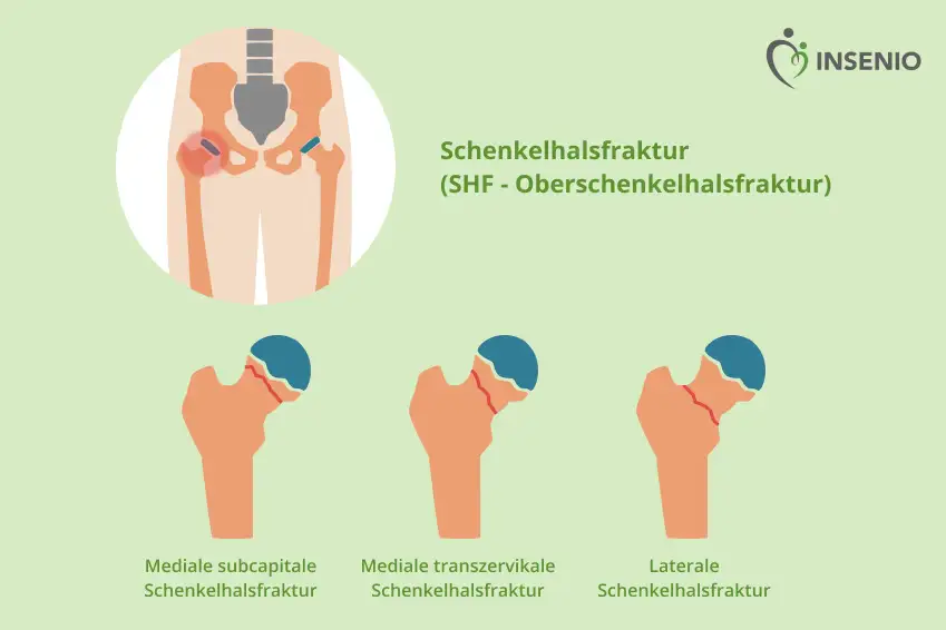 Schenkelhalsbruch Infografik